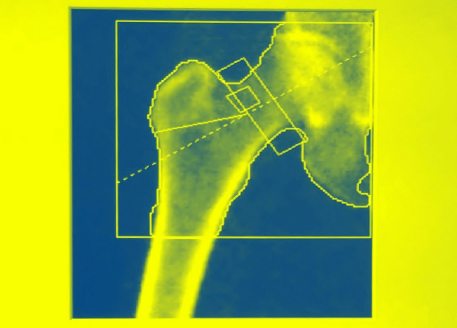 Don’t Delay! Osteoporosis screening critical to prevention.