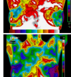 Breast Thermography: A complimentary approach to prevention and early detection of breast cancer